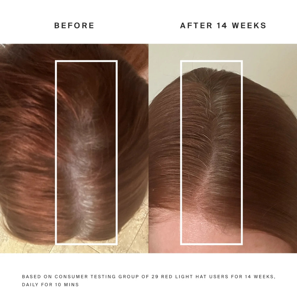 Before and after comparison of hair growth treatment on a person's scalp.